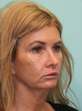 Before treatment